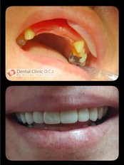 Dental Bridges - Clínica Dental O.C.I Liberia