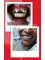 Clínica Dental O.C.I Liberia - Crowns metal free 
