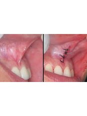 Lingual Frenectomy - Clínica Dental O.C.I Liberia