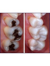 White Filling - Clínica Dental O.C.I Liberia