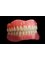 Clínica Dental O.C.I Liberia - Full dentures characterizade 