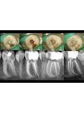 Molar Root Canal - Clínica Dental O.C.I Liberia