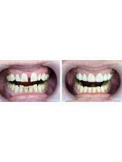 Composite Veneers - Clínica Dental O.C.I Liberia