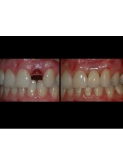 Immediate Dentures - Clínica Dental O.C.I Liberia