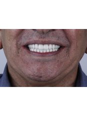 All-on-4 Dental Implants - Aesthetic Dental Care