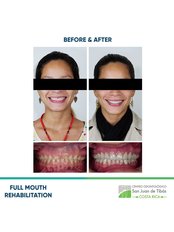 Full Mouth Rehabilitation  - Centro Odontologico San Juan de Tibás