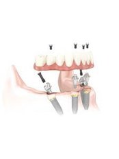 All-on-4 Dental Implants - Costa Rica Dental Implants Clinic