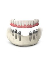 All-on-6 Dental Implants - Costa Rica Dental Implants Clinic