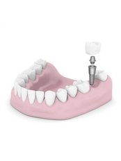 Dental Implants - Costa Rica Dental Implants Clinic