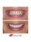 Prisma Dental - Smile Makeover with Zirconium Corwns 