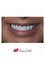 Prisma Dental - A beautiful smile! Zirconia crowns. 