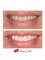 Prisma Dental - Smile makeover with Zirconia veneers. 