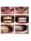 Costa Rica Dental Team - Fixing aesthetics with full mouth restoration with crowns 