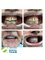 Costa Rica Dental Team - full mouth restoration with crowns 