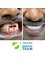 Costa Rica Dental Team - Upper anterior implants restored 