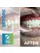 Costa Rica Dental Team - full mouth restoration with porcelain crowns 