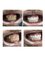 Costa Rica Dental Team - Full mouth restoration with crowns on a bruxer patient. crown lengthening were performed to shape the gum on the anterior teeth and make them even 