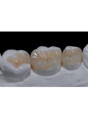 Inlay or Onlay - Dental Solutions Tamarindo