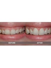 Gum Contouring and Reshaping - Dental Solutions Tamarindo