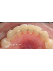 Orthodontic Retainer - Dental Solutions Tamarindo