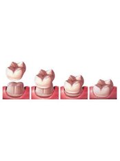 Dental Crowns - Dental Solutions Tamarindo