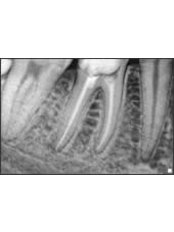 Root canals - Dental Clinic Dunđerović Knez