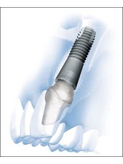 Dental Implants - Dental Clinic Dunđerović Knez