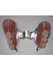 Chrome Dentures - Dental Clinic Dunđerović Knez