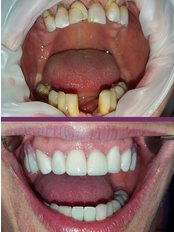 Zirconia Crown - Dental Centar Župa