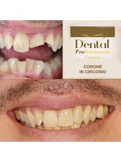 Zirconia Crown - DentalPro