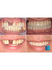 All-on-4 Dental Implantats - ORIGINAL!! - Dental Polyclinic Breyer