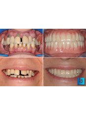 All-on-4 Dental Implantats - ORIGINAL!! - Dental Polyclinic Breyer
