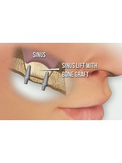 Sinus Lift - Dental Care Croatia