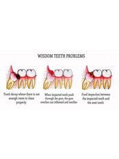 Wisdom Tooth Extraction - Dental Care Croatia