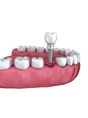 Sofortimplantate - Dental Care Croatia - Dr. Marina Ježina