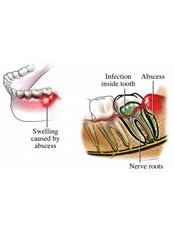 Treatment of Dental Abscess - Dental Care Croatia