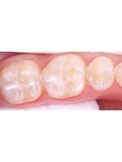 Dental Sealant - Dental Care Croatia