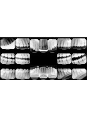 Digital Dental X-Ray - Dental Care Croatia