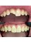 Dental Clinic Burow - Composite restauration 