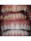 Dental Clinic Burow - dental crowns 