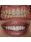 Dental Clinic Burow - Combination of crowns and veeners 