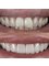 Dental Clinic Burow - Dental crowns 