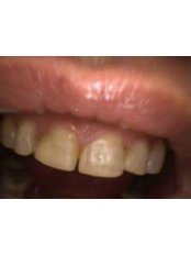 Composite Veneers - HVAR Esthetic Dental Studio