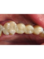 Dental Bridges - HVAR Esthetic Dental Studio