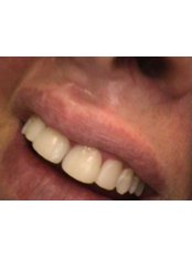 Teeth Contouring and Reshaping - HVAR Esthetic Dental Studio