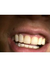 Teeth Whitening - HVAR Esthetic Dental Studio