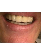 Dental Crowns - HVAR Esthetic Dental Studio