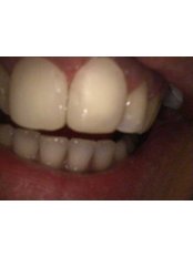 Dental Bonding - HVAR Esthetic Dental Studio