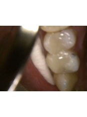 White Filling - HVAR Esthetic Dental Studio