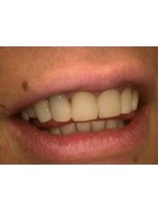 Teeth Whitening - HVAR Esthetic Dental Studio